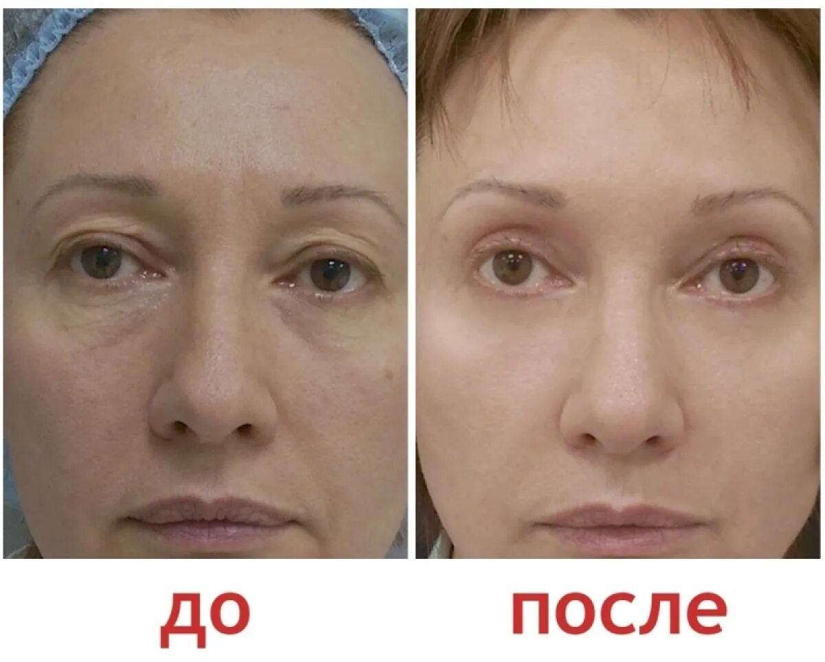 Пластика нижних век фото до и после Веко прайс: найдено 81 изображений