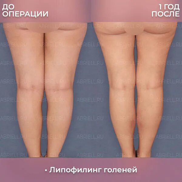 Пластика ног фото до и после Липофилинг голеней и бедер: цены в Санкт-Петербурге, фото результатов, отзывы
