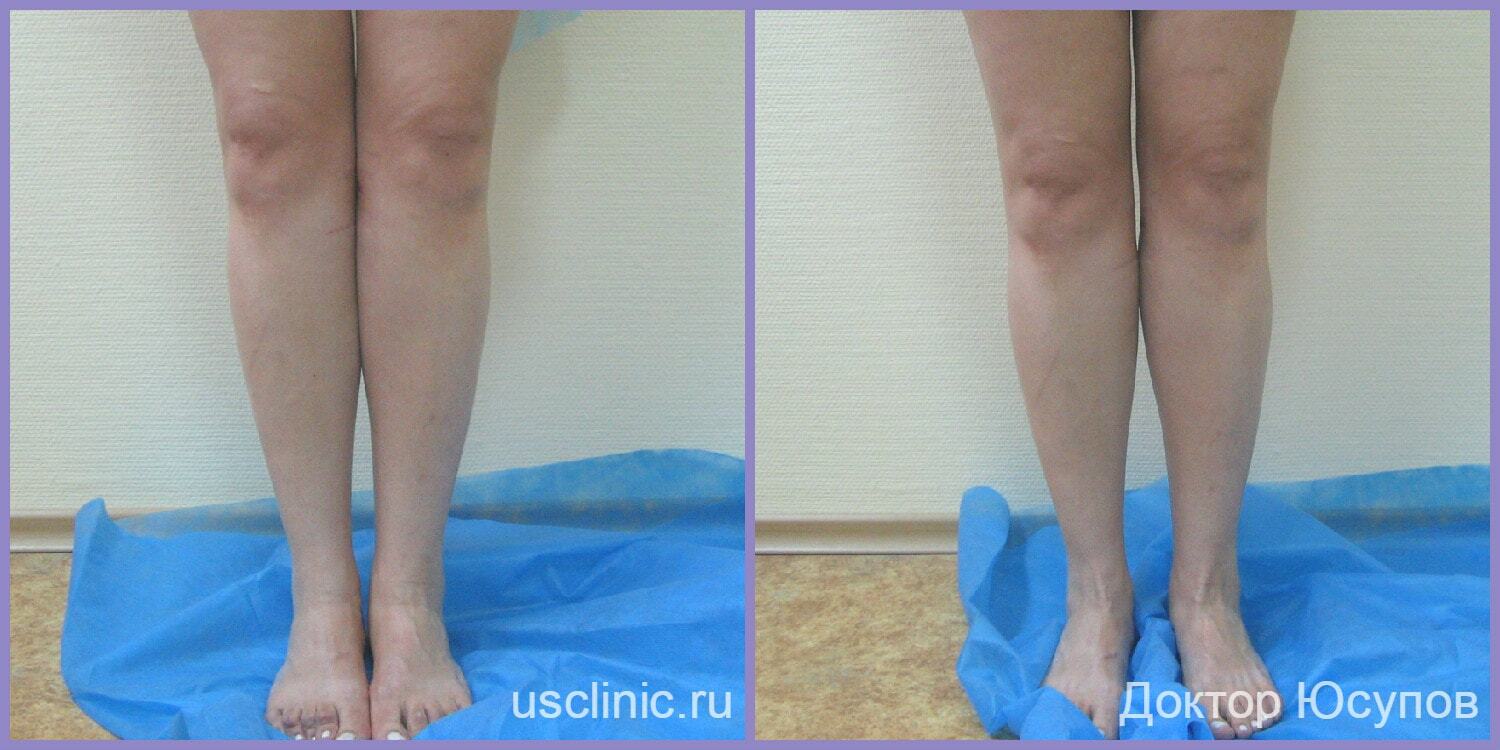 Пластика ног фото до и после Круропластика в US CLINIC - Доктор Юсупов