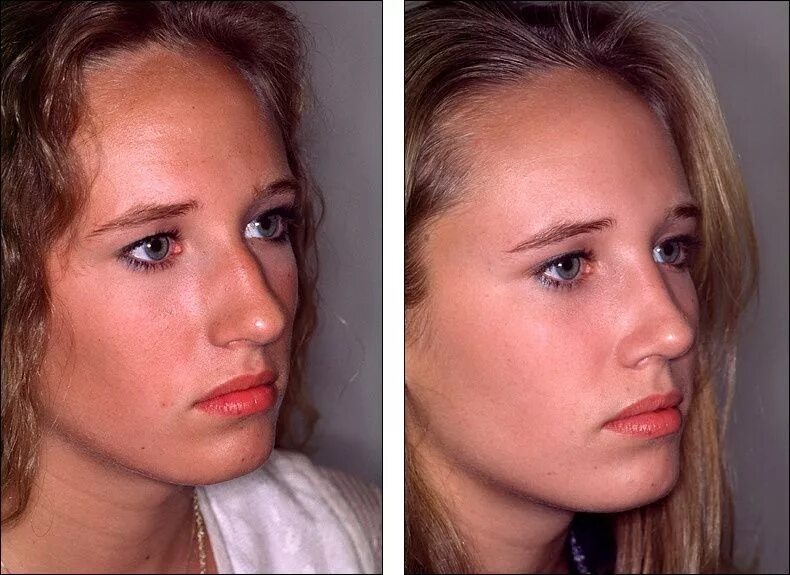 Пластика носа до и после фото Steven M. Denenber, M.D. Rhinoplasty Laser hair, Rhinoplasty, Broken nose