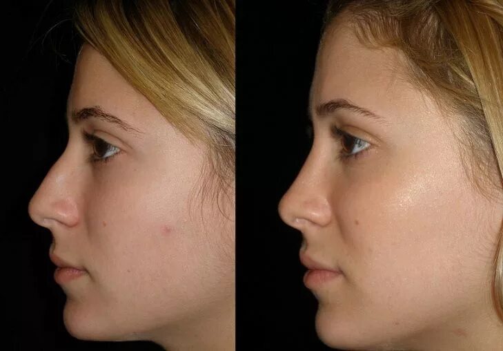 Пластика носа до и после фото Rhinoplasty, Before and After Rhinoplasty, Rhinoplasty cost, Rhinoplasty before 