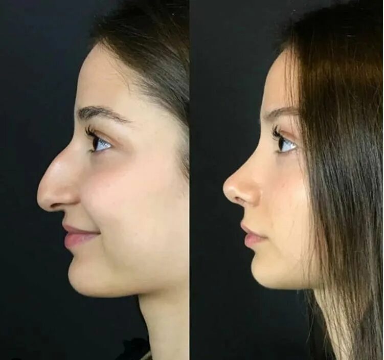 Пластика носа до и после фото Pin on Nose Job