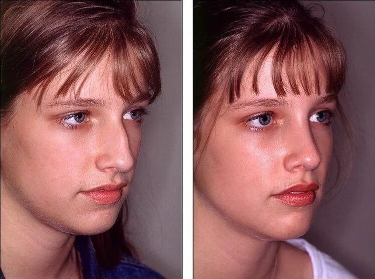 Пластика носа до и после фото Pin by Mobina Rajabi on Nose Nose job, Nose plastic surgery, Nose contouring