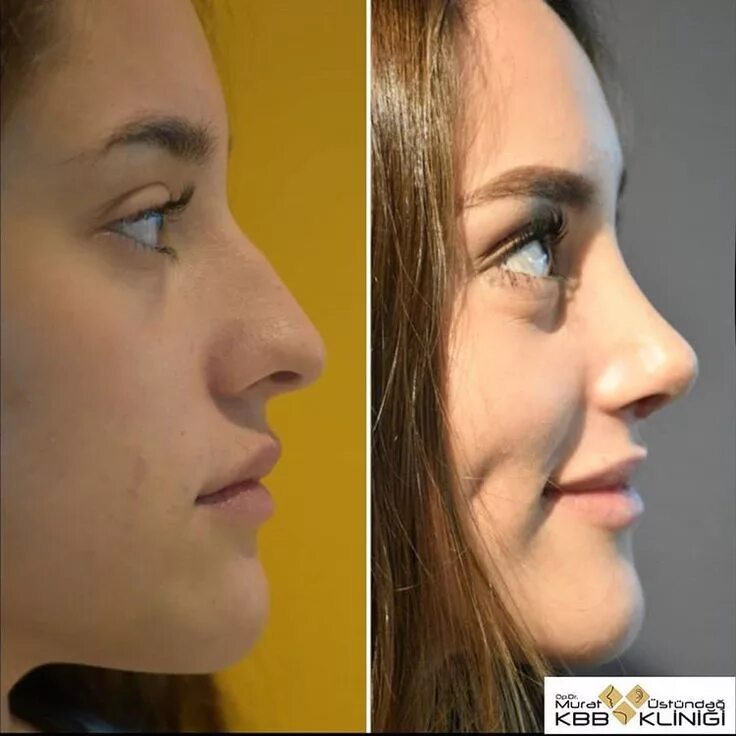 Пластика носа до и после фото женщины nosejob rhinoplasty rinoplastia surgery plastic surgery cirugía Nose surgery rhi