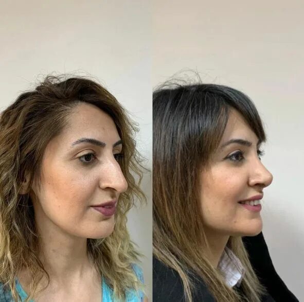 Пластика носа до и после фото женщины The nose is the main part of the face: photos of girls who have been transformed