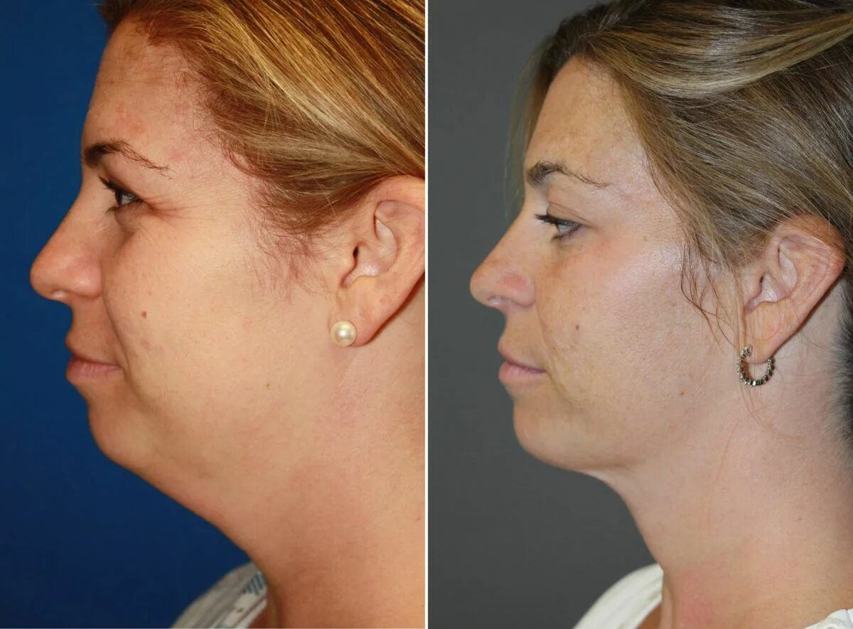 Пластика подбородка фото до и после женщины Pin on Cosmetic Surgery Blogs