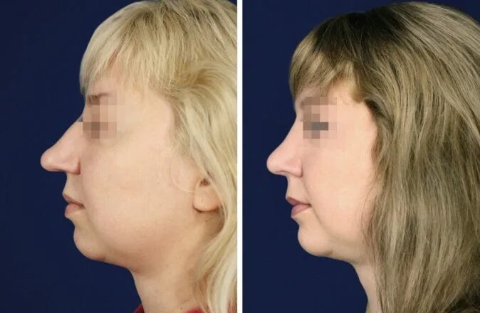 Пластика подбородка фото до и после женщины Before And After Nuevo Clinic