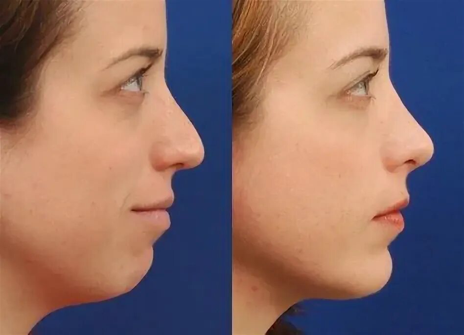 Пластика подбородка фото до и после женщины 10 популярных идей на тему "chin implants before and after" для вдохновения