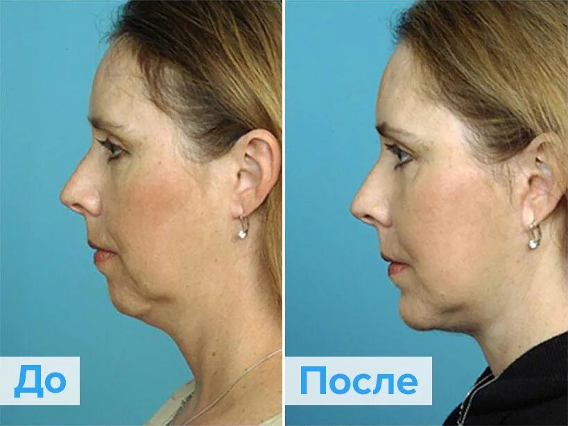 Пластика подбородка фото до и после женщины Mentoplasty - RomiTal clinic