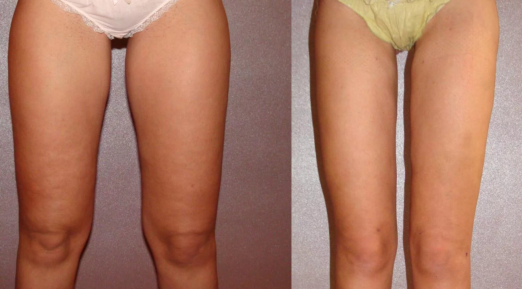 Пластика половых губ до и после фото Liposuction - Estetik Ramita Dr Dejan Milutinovic