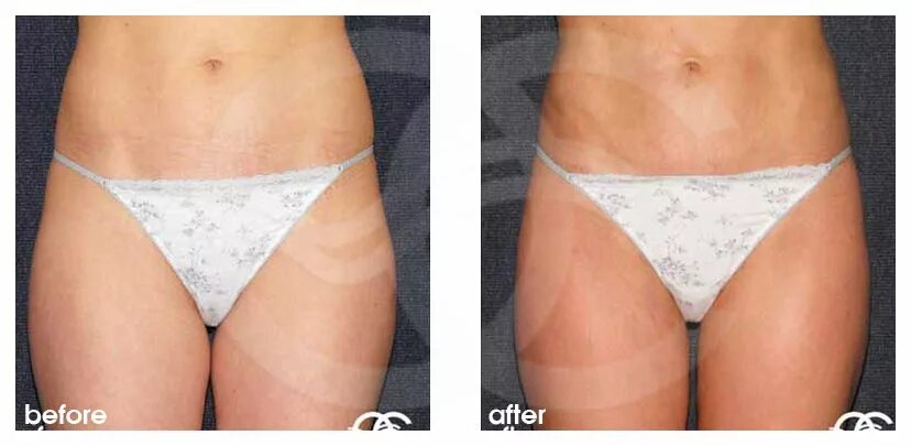 Пластика половых губ до и после фото Index of /images/liposuction