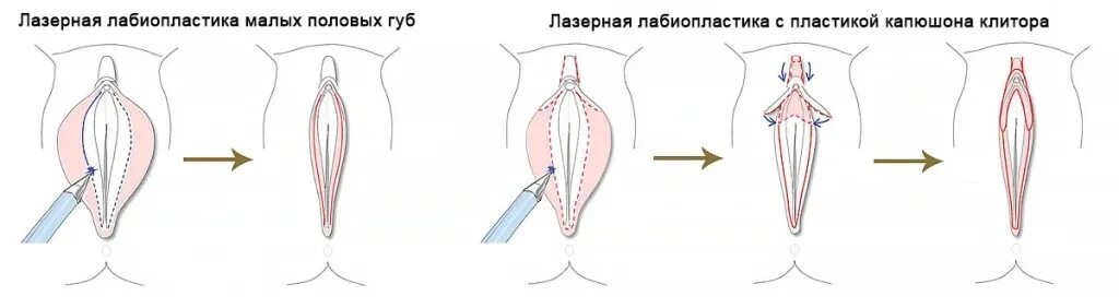 Пластика половых губ до и после фото Интимная пластика (лабиопластика) интервью от Эс Класс Клиник Ульяновск