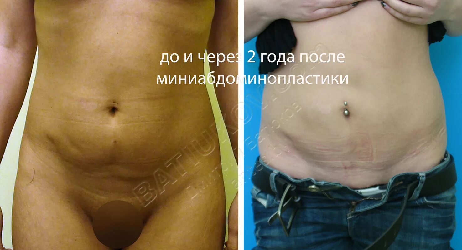 Пластика половых губ до и после фото Абдоминопластика живота: фото до и после, вся суть (полезно знать)