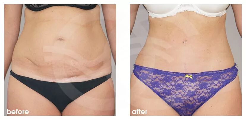 Пластика половых губ до и после фото Ocean Clinic Абдоминопластика Марбелья Испания