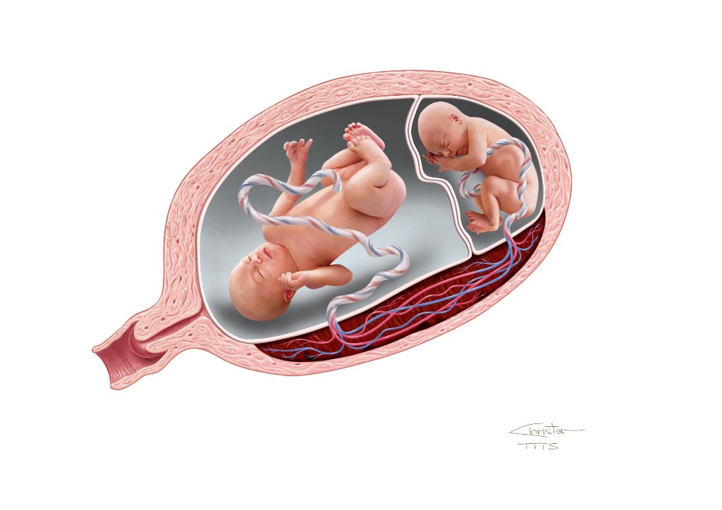 Плацента как выглядит после родов настоящая Umbilical cord with twins