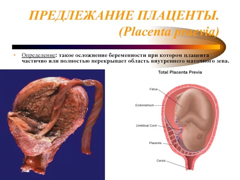 Плацента как выглядит после родов настоящая Кровотечения во II половине беременности и в родах