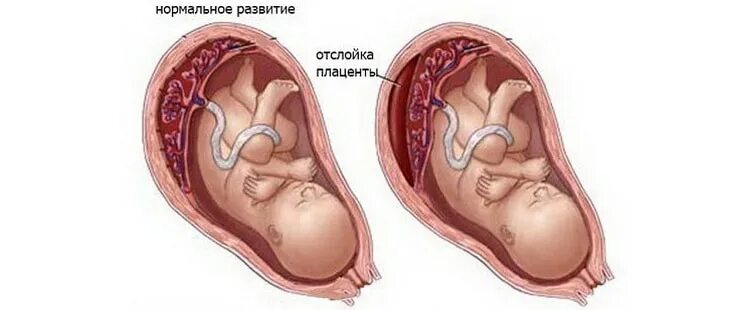 Плацента как выглядит после родов настоящая Что такое плацента, какую функцию она выполняет у беременных женщин, что происхо