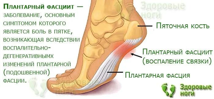 Плацентарный фасциит стопа симптомы и лечение фото Картинки НОЕТ ПЯТКА ЛЕВОЙ НОГИ