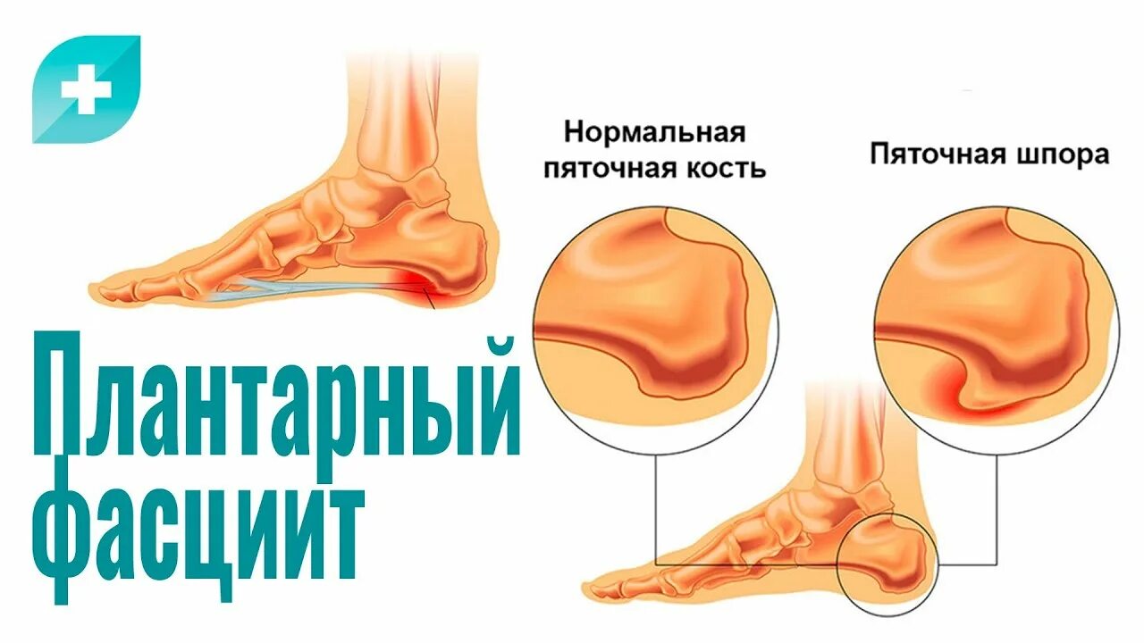 Плацентарный фасциит стопа симптомы и лечение фото Плантарный фасциит: причины, симптомы и лечение - YouTube