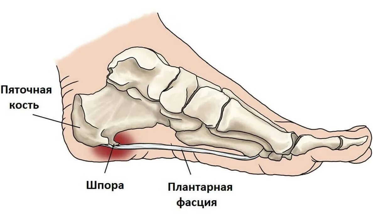 Плацентарный фасциит стопа симптомы и лечение фото Диагностический центр № 3 г. Москвы