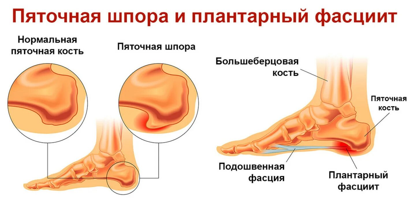 Плацентарный фасциит стопа симптомы и лечение фото Плантарный фасциит стопы как лечить