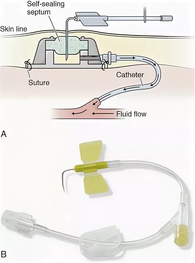 Подключение системы к катетеру Indwelling Vascular Devices: Emergency Access and Management Veterian Key