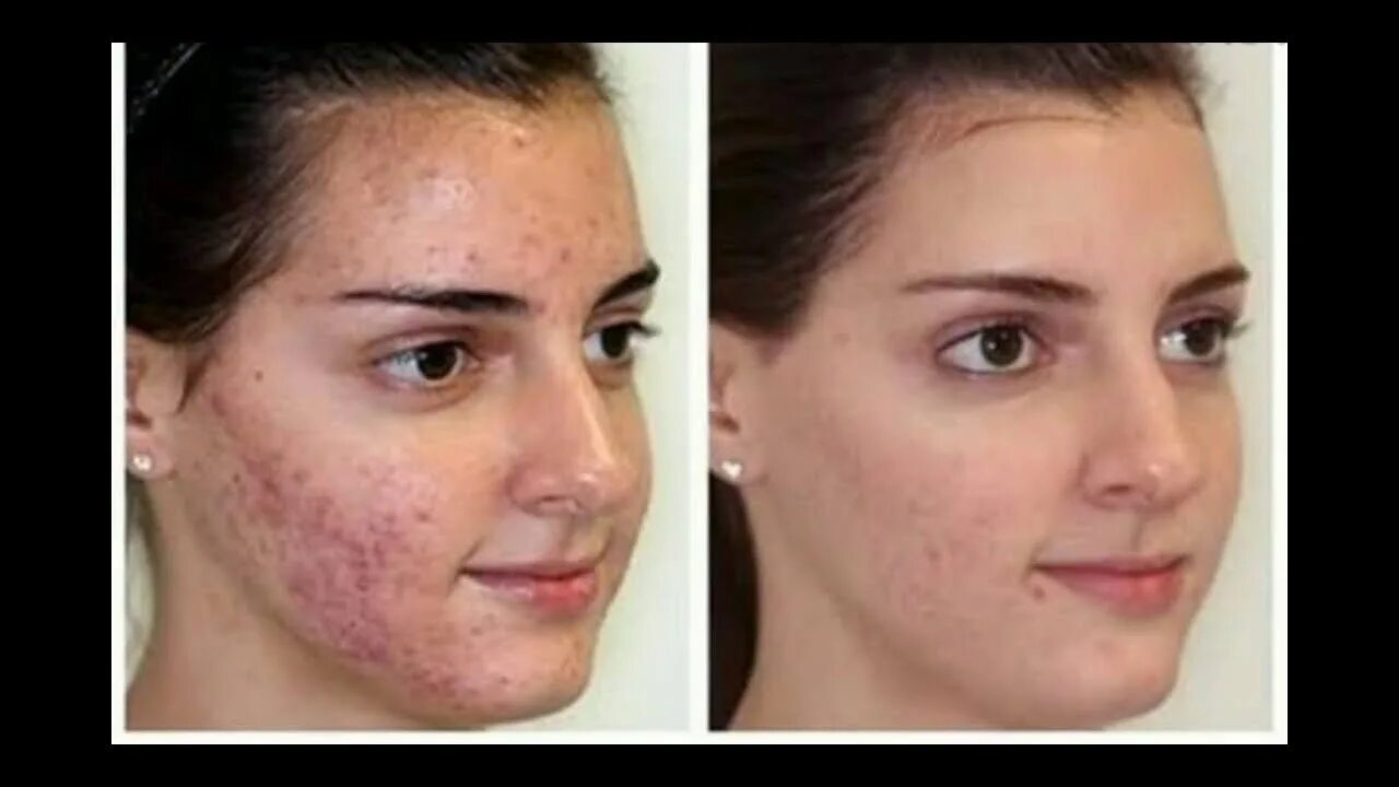 Подкожные клещи фото на теле How to treat a deep painfull pimples - YouTube