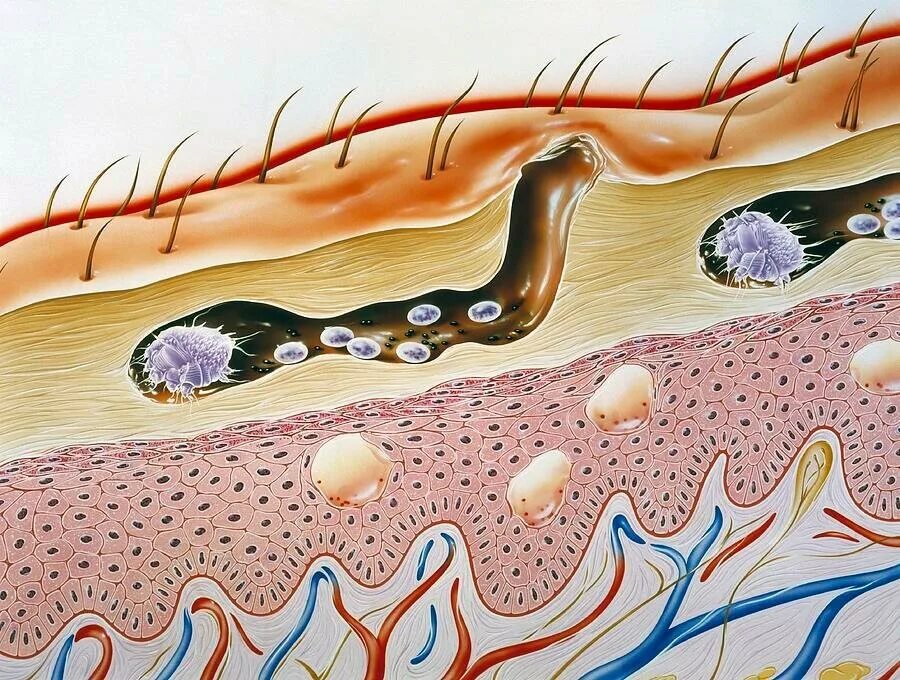 Подкожные клещи фото на теле Чесотка