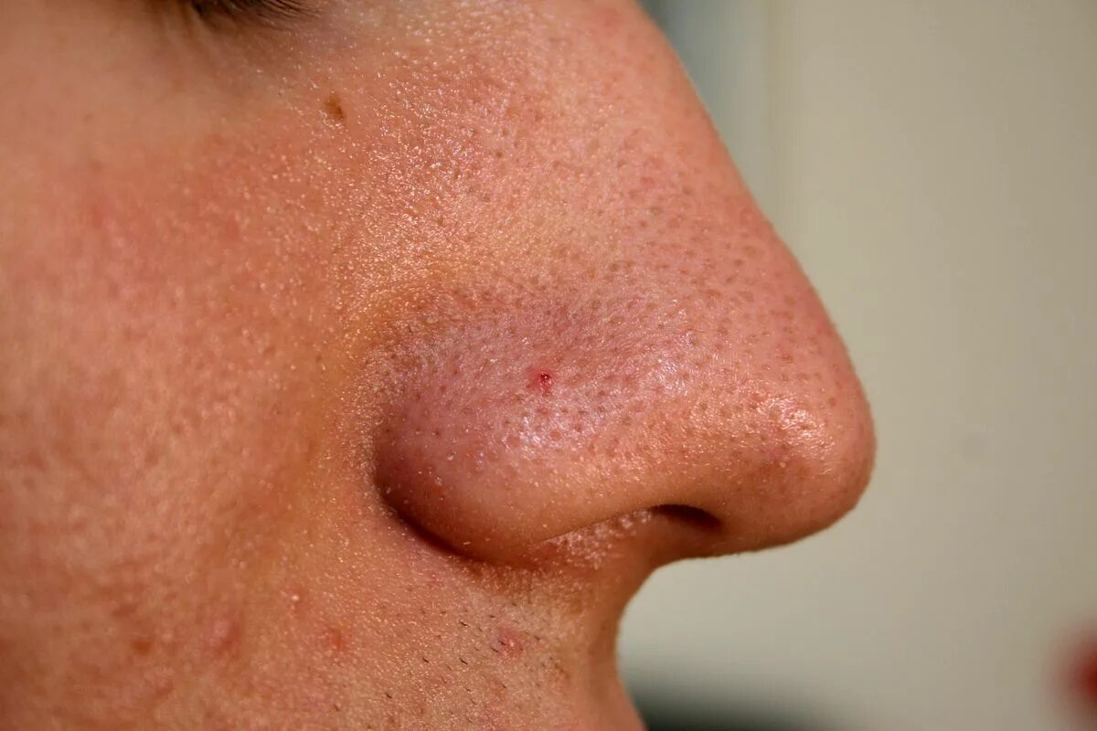 Подкожные лице фото Файл:Nose with Blackhead 2009.jpg - Википедия