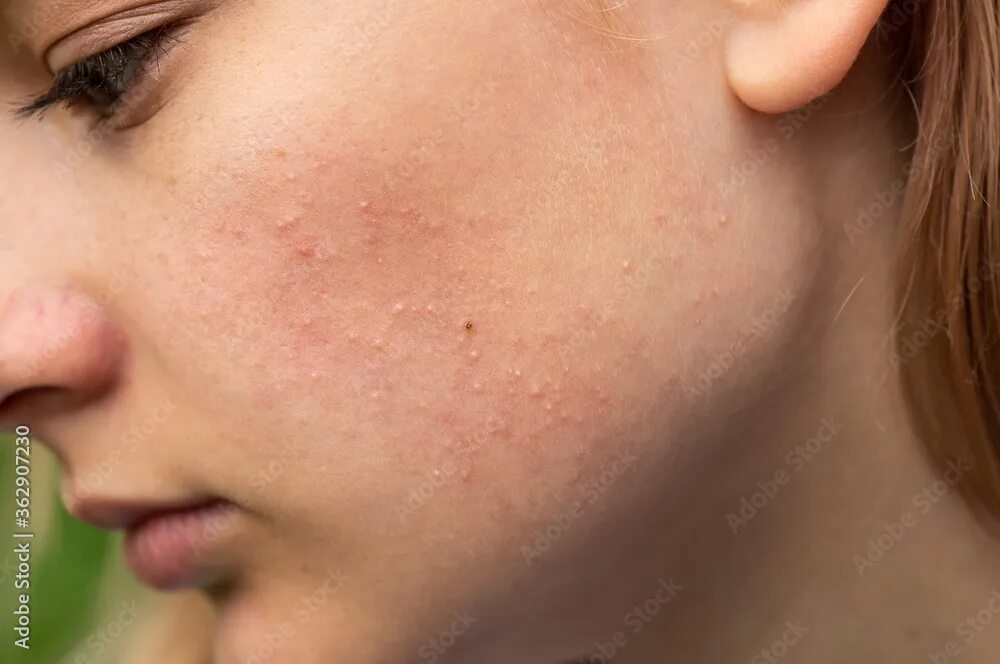 Подкожные лице фото Problematic skin. Acne and red festering pimples on the face of a young girl. Fa