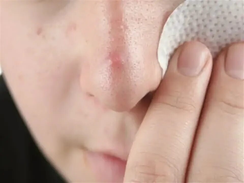 Подкожные прыщи на лице фото How To Get Rid Of Blackheads.How To Get Rid Of Stretch Marks.How To Get Rid Of P