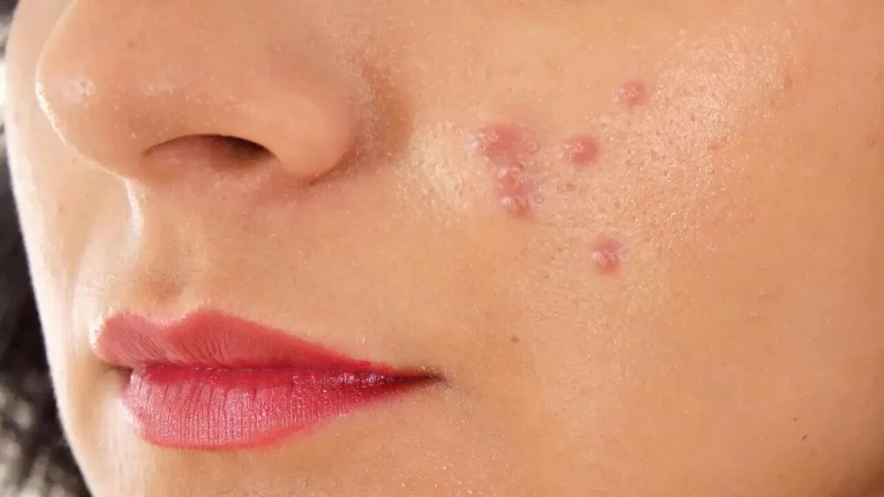 Подкожные прыщи на лице фото Oily Skin Pimples Remove At Home / Oily Skin Se Pimple Hatane Ka Tarika - YouTub