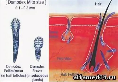 Подкожный клещ демодекс фото Частный дерматолог венеролог Волгоград Клиника АЛЬФАМЕД - Демодекоз