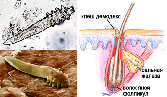 Подкожный клещ демодекс фото Клещ, который размножается по ночам на вашем лице. Рискнёте посмотреть видео? Ре