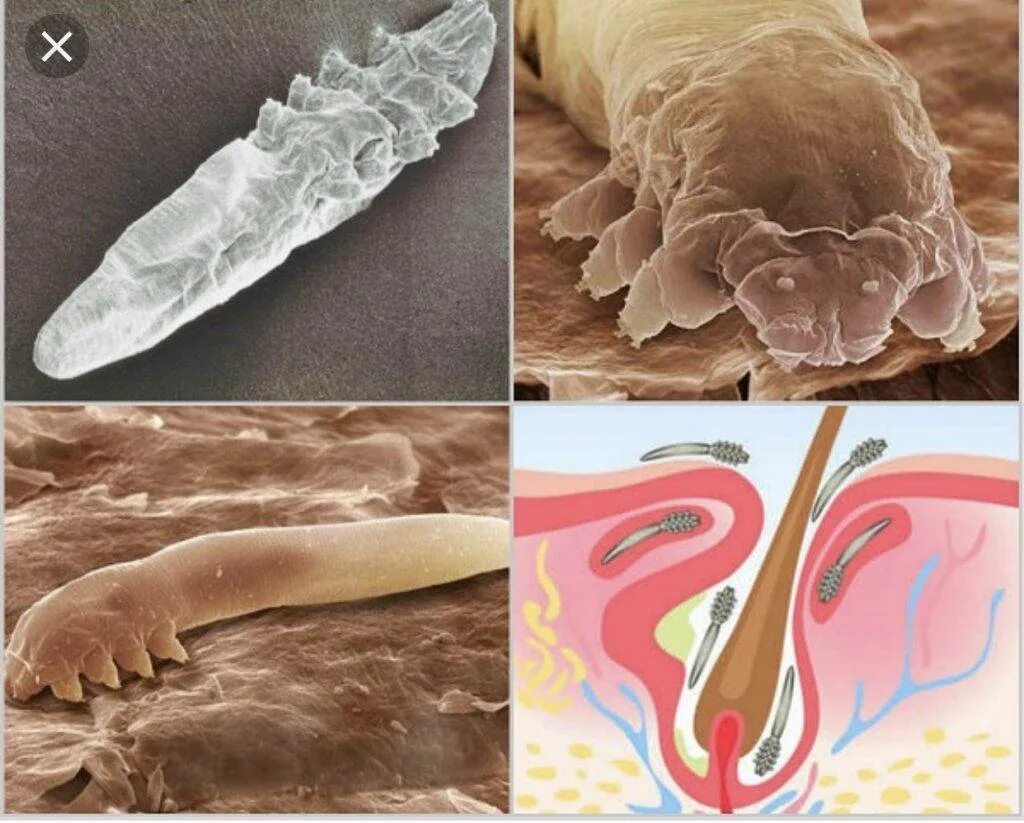 Подкожный клещ демодекс фото Клещ Демодекс: симптомы и лечение кожи лица