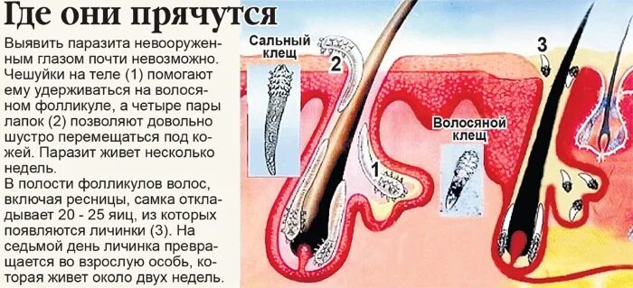 Подкожный клещ фото описание Демодекоз на лице у человека. Схема лечения, препараты, народные средства