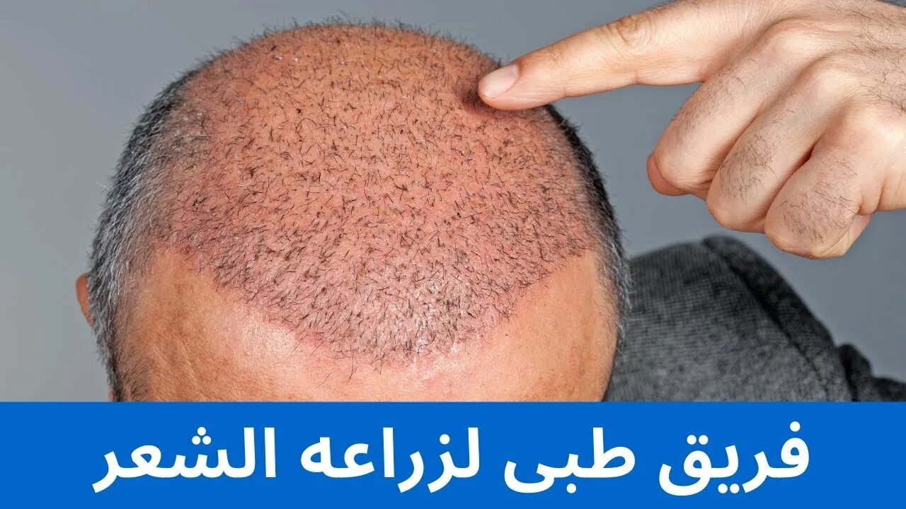 Подкожный клещ на голове фото فريق طبى لزراعه الشعر ورأى احد عملائنا بعد النتيجه Change me - YouTube