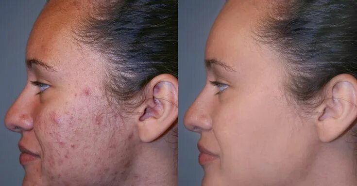 Подкожный клещ на лице фото и лечение Clique AQUI para saber mais... Tratamento de acne, Cicatriz de acne, Espinhas