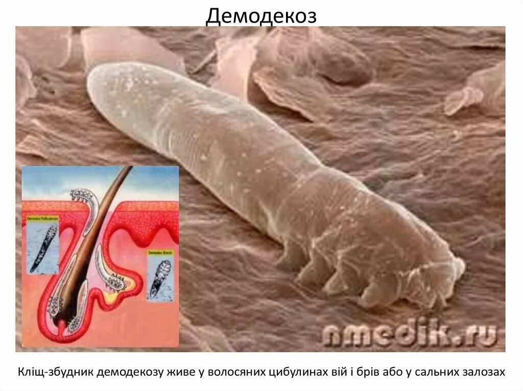 Подкожный клещ на ногах фото Хвороби та ураження шкіри - презентация онлайн