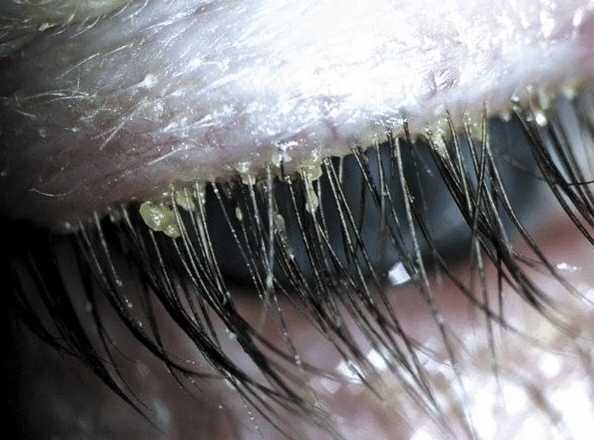 Подкожный клещ на ресницах фото Your Beautifully Mascaraed Lashes Are Probably Infested With Mites - FamilyToday