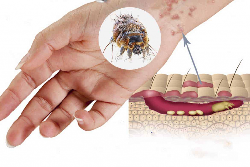 Подкожный клещ на руках фото О мерах профилактики чесотки