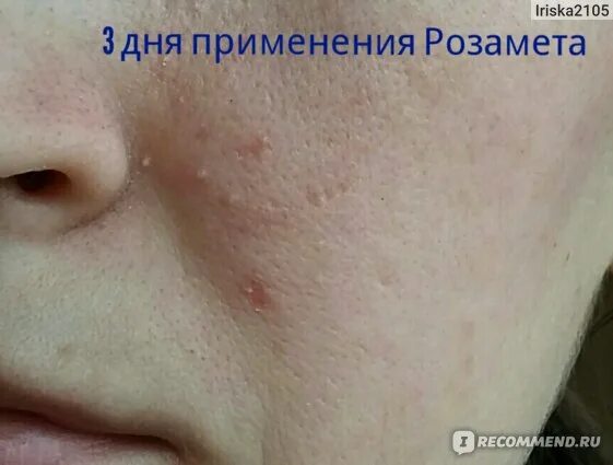 Подкожный клещ на спине фото Противомикробные средства Розамет - "Лечение демодекоза Розаметом. Наконец мне у