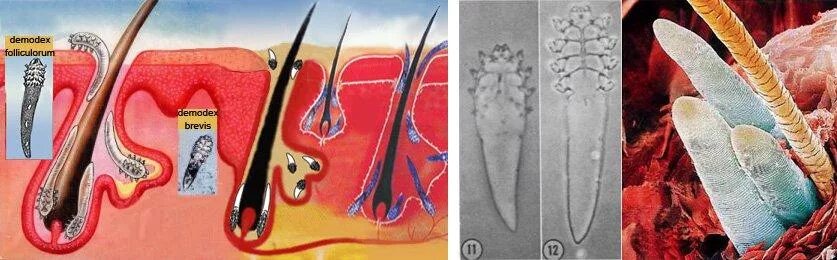 Подкожный клещ у человека лечение фото Демодекоз - лечение и симптомы, причины появления