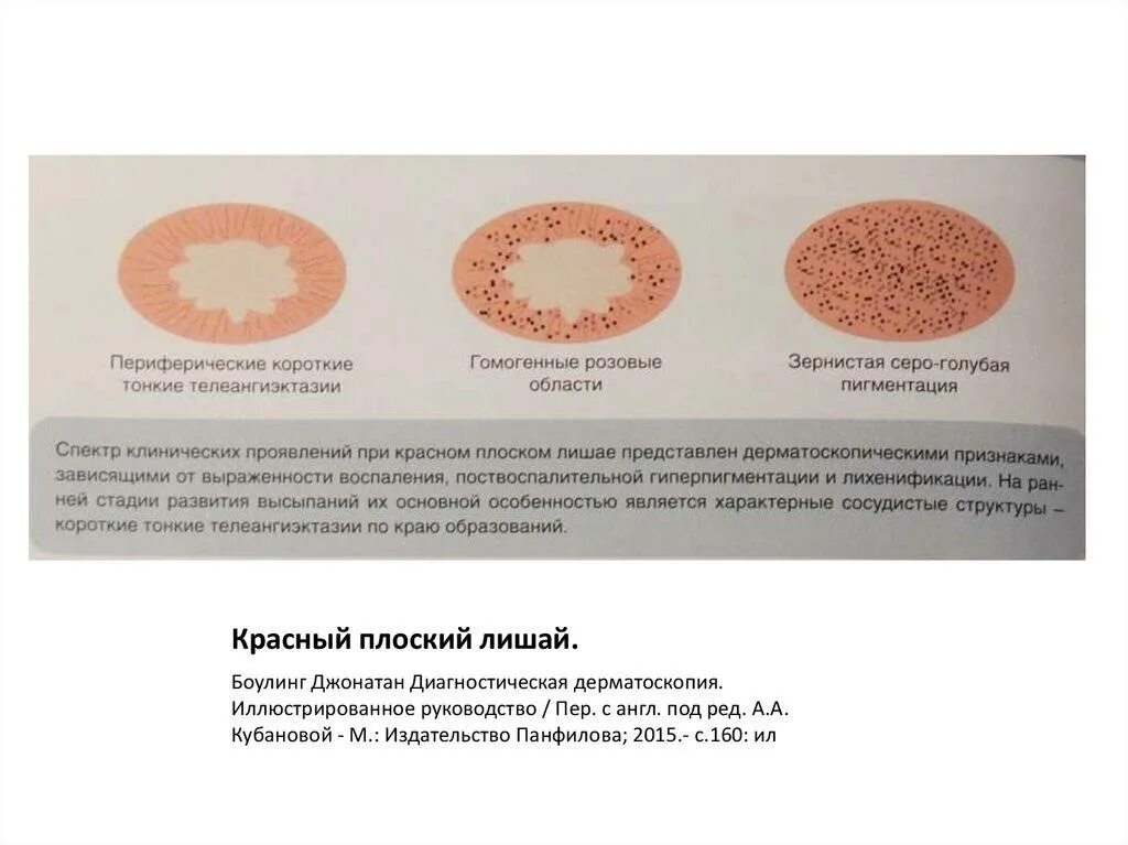 Подкожный лишай у человека симптомы лечение фото Лишай красный плоский: причины, симптомы и лечение в статье детского дерматолога