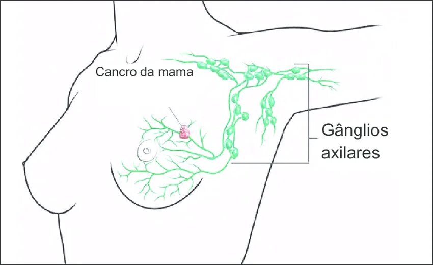 Подмышечные лимфоузлы расположение у женщин схема Gânglios linfáticos perto de um tumor da mama Download Scientific Diagram