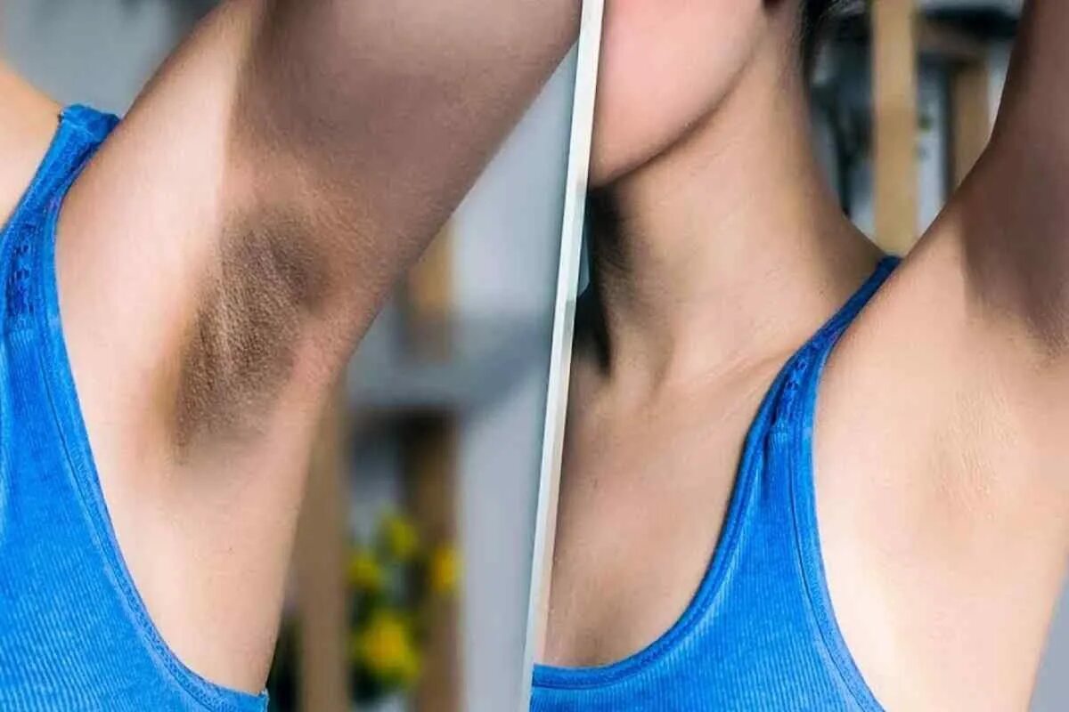 Подмышки какой лишай бывает фото Dark armpits: why they appear and how to get rid of dark armpits Many girls have