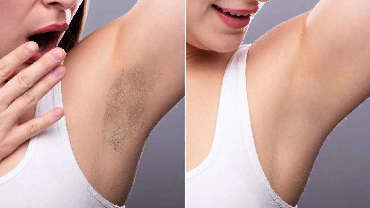 Подмышки какой лишай бывает фото Under Arm Whitening Remove Your Underarm Dark in 5 Minute - YouTube