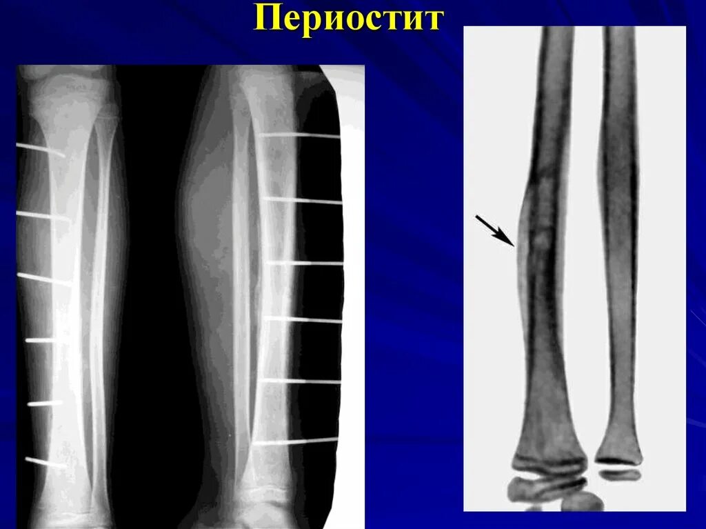 Поднадкостничная гематома большеберцовой кости фото Картинки ВОСПАЛЕНИЕ БОЛЬШЕБЕРЦОВОЙ