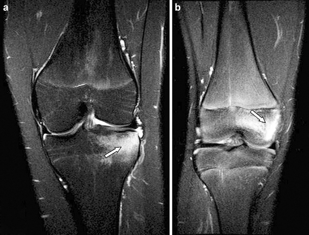 Поднадкостничная гематома большеберцовой кости фото Increasing feasibility and patient comfort of MRI in children with juvenile idio