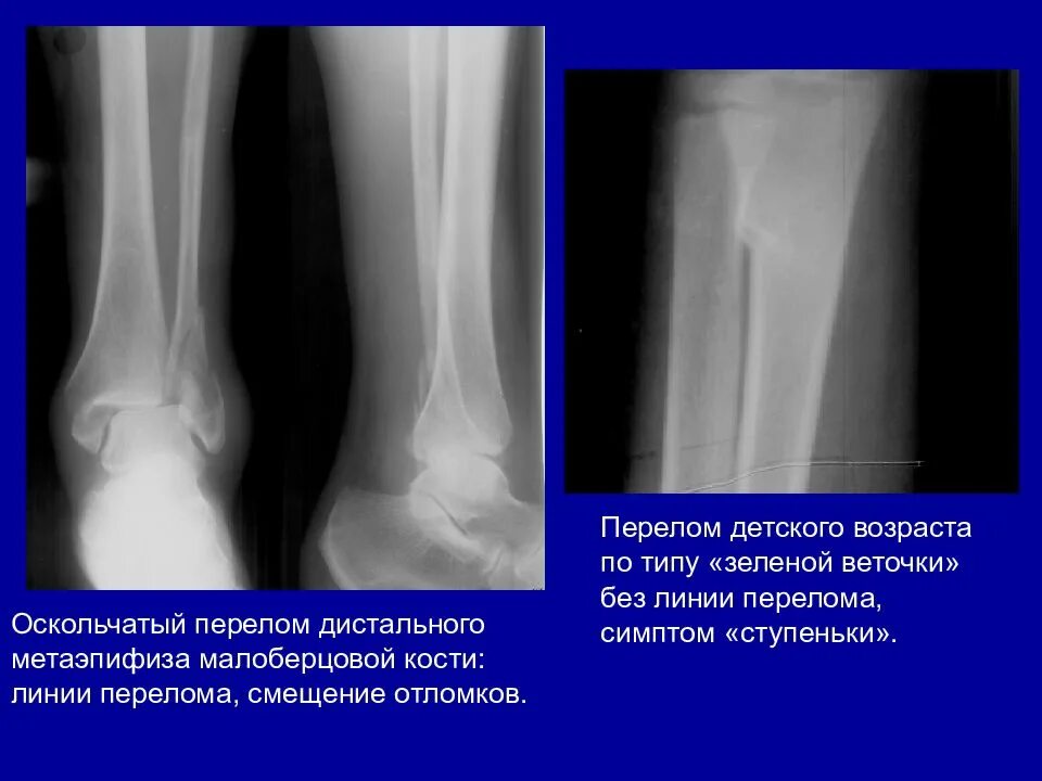 Поднадкостничная гематома большеберцовой кости фото Презентация переломы большеберцовой кости
